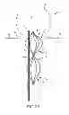 Fig. 20 - Vascular remodeling device