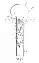Fig. 21 - Vascular remodeling device