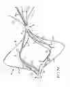 Fig. 34 - Vascular remodeling device
