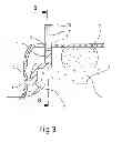 Fig. 03 - SECURING OF A PANE OF GLASS PROVIDED WITH AN INSERT-MOULDED EDGE SECTION, IN PARTICULAR A PANE OF GLASS FOR AN AUTOMOBILE