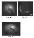 Fig. 09 - Method for reduced field of view MRI in an inhomogeneous field with rapid outer volume suppression