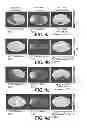 Fig. 05 - Passive Bfield shimming
