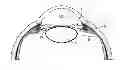 Fig. 01 - Direct visualization system for glaucoma treatment