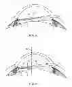 Fig. 06 - Direct visualization system for glaucoma treatment