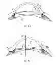Fig. 07 - Direct visualization system for glaucoma treatment