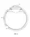 Fig. 06 - Delivery system for ocular implant