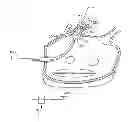 Fig. 01 - CIRCUMFERENTIAL ABLATION DEVICE ASSEMBLY