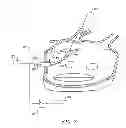 Fig. 04 - CIRCUMFERENTIAL ABLATION DEVICE ASSEMBLY