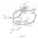 Fig. 05 - CIRCUMFERENTIAL ABLATION DEVICE ASSEMBLY