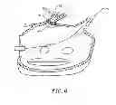 Fig. 07 - CIRCUMFERENTIAL ABLATION DEVICE ASSEMBLY