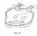Fig. 10 - CIRCUMFERENTIAL ABLATION DEVICE ASSEMBLY