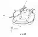 Fig. 13 - CIRCUMFERENTIAL ABLATION DEVICE ASSEMBLY