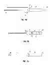 Fig. 02 - MODULAR CATHETER
