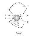 Fig. 02 - Method for planning positioning of a ball joint prosthesis
