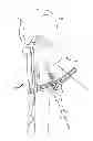 Fig. 01 - Methods and devices for ligament repair