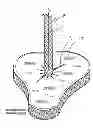 Fig. 01 - WOUND CLOSURE DEVICE INCLUDING SUCTION STEP SLEEVE