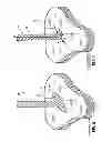 Fig. 06 - WOUND CLOSURE DEVICE INCLUDING SUCTION STEP SLEEVE