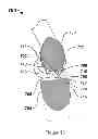 Fig. 15 - Method for modifying the wettability and other biocompatibility characteristics of a surface of a biological material by the application of beam technology and biological materials made thereby