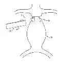 Fig. 01 - Vascular bands and delivery systems therefor