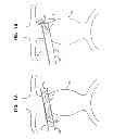 Fig. 02 - Vascular bands and delivery systems therefor