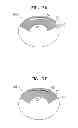 Fig. 08 - Vascular bands and delivery systems therefor