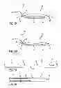 Fig. 09 - Method and apparatus for thread transection of a ligament