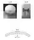 Fig. 02 - Multiple component bone void filling implant