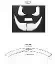 Fig. 03 - Multiple component bone void filling implant