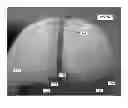 Fig. 09 - Multiple component bone void filling implant