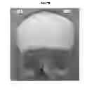 Fig. 10 - Multiple component bone void filling implant