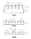 Fig. 05 - Method of manufacturing an orthodontic bracket having a laser shaped green body