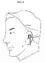 Fig. 10 - Earphone device