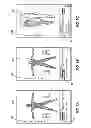 Fig. 09 - Automated search to identify a location for electrical stimulation to treat a patient
