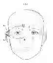 Fig. 02 - Implanter device for nerve stimulation and method of using the same