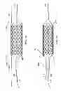 Fig. 07 - Deployment of stents within bifurcated vessels