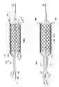 Fig. 09 - Deployment of stents within bifurcated vessels