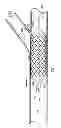 Fig. 14 - Deployment of stents within bifurcated vessels