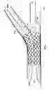 Fig. 16 - Deployment of stents within bifurcated vessels