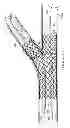 Fig. 18 - Deployment of stents within bifurcated vessels