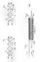 Fig. 20 - Deployment of stents within bifurcated vessels