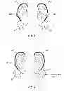 Fig. 04 - Method and apparatus for treating various neurological conditions