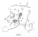 Fig. 02 - Systems and methods for adjusting electrical therapy based on impedance changes