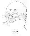 Fig. 22 - Methods, systems and devices for non-invasive open ventilation for treating airway obstructions