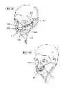 Fig. 28 - Methods, systems and devices for non-invasive open ventilation for treating airway obstructions