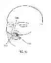 Fig. 35 - Methods, systems and devices for non-invasive open ventilation for treating airway obstructions