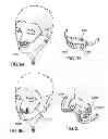 Fig. 65 - Methods, systems and devices for non-invasive open ventilation for treating airway obstructions