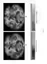 Fig. 10 - SYSTEMS AND METHODS FOR MEASURING LONGITUDINAL BRAIN CHANGE INCORPORATING BOUNDARY-BASED ANALYSIS WITH TENSOR-BASED MORPHOMETRY