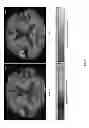 Fig. 11 - SYSTEMS AND METHODS FOR MEASURING LONGITUDINAL BRAIN CHANGE INCORPORATING BOUNDARY-BASED ANALYSIS WITH TENSOR-BASED MORPHOMETRY