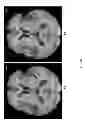 Fig. 12 - SYSTEMS AND METHODS FOR MEASURING LONGITUDINAL BRAIN CHANGE INCORPORATING BOUNDARY-BASED ANALYSIS WITH TENSOR-BASED MORPHOMETRY