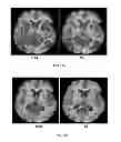 Fig. 14 - SYSTEMS AND METHODS FOR MEASURING LONGITUDINAL BRAIN CHANGE INCORPORATING BOUNDARY-BASED ANALYSIS WITH TENSOR-BASED MORPHOMETRY